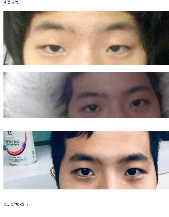 남자 쌍꺼풀 수술 후기