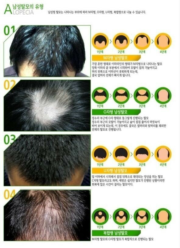 탈모 유형
